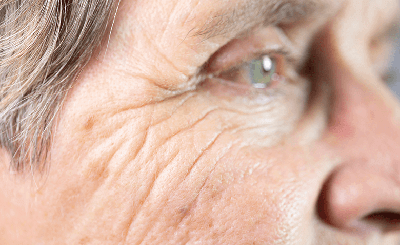 ALA-Photodynamic-Therapy-for-Actinic-Keratoses| Skin Plus Compounding Pharmacy