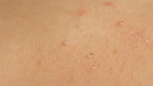 In-Clinic Use of Cantharidin for the Treatment of Molluscum Contagiosum