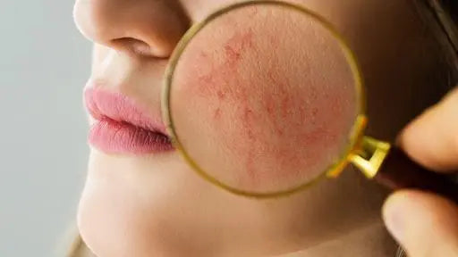 Subantimicrobial Dosing of Doxycycline for Acne and Rosacea